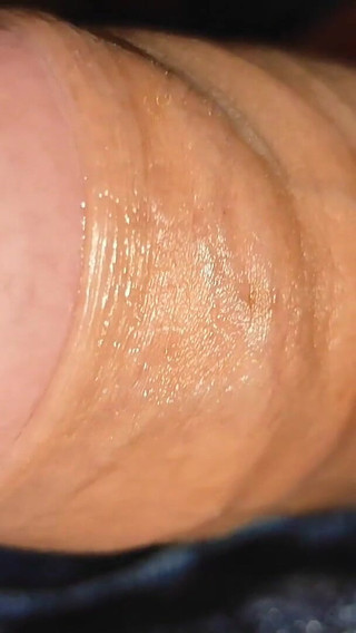 Difficult Fluid Control Due to Straight Phimosis.