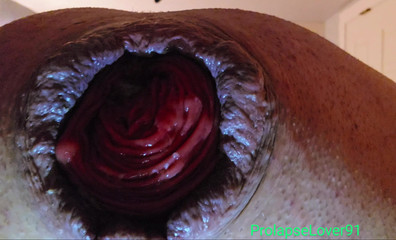 Closeup Anal Prolapse with Inflatable Buttplug