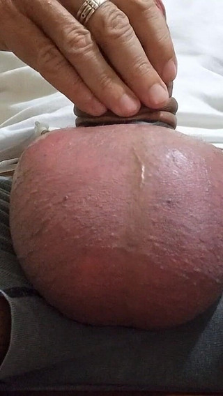 Silicone Rings and Saline